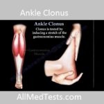 ankle and patellar clonus