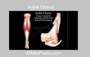 ankle and patellar clonus